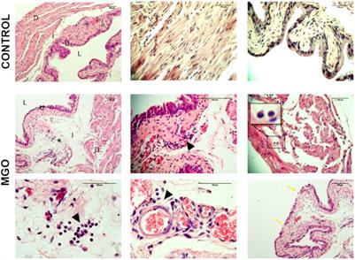 Methylglyoxal, a Reactive Glucose Metabolite, Induces Bladder Overactivity in Addition to Inflammation in Mice